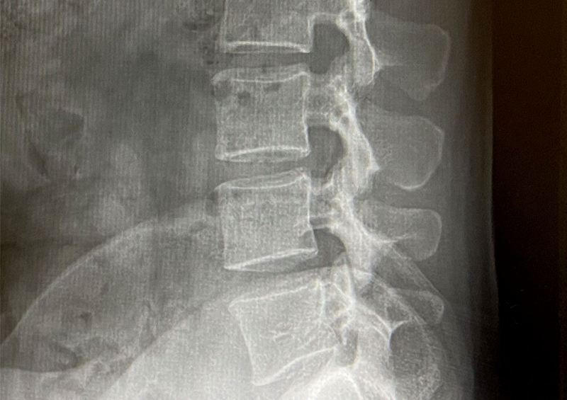 レントゲン検査