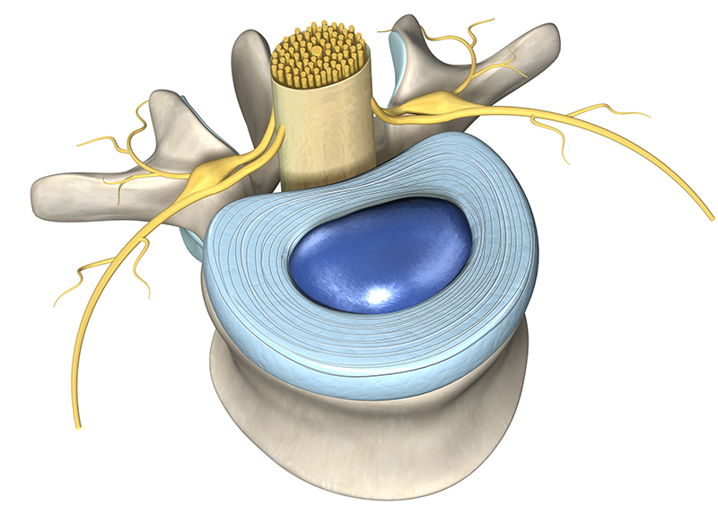 腰椎椎間板ヘルニア