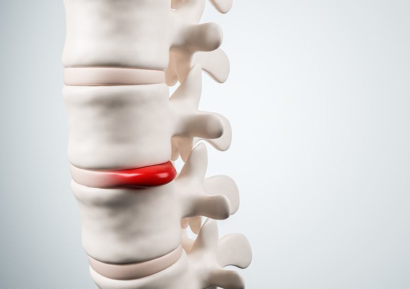 腰椎椎間板ヘルニア模式図