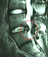 腰椎椎間板ヘルニア精密検査