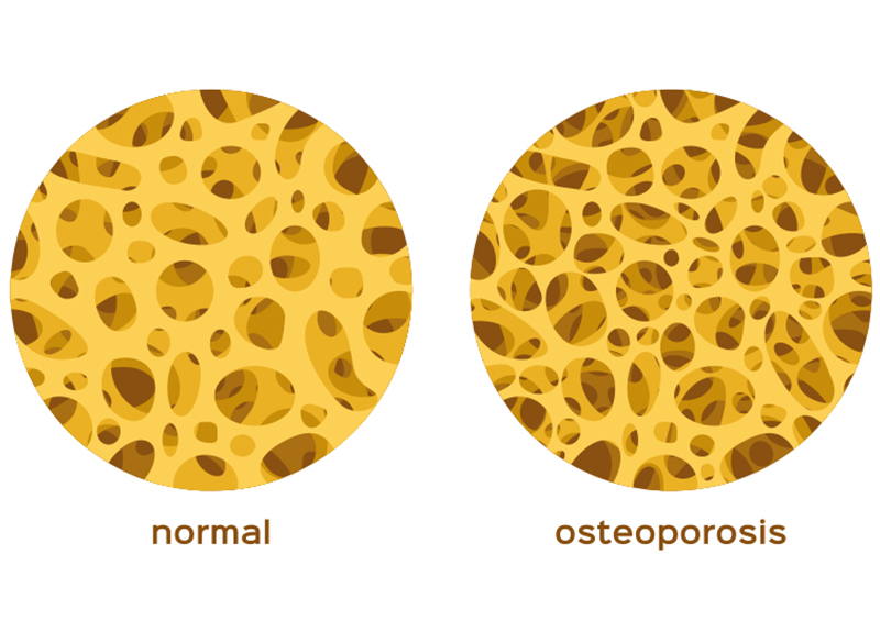 骨粗しょう症とは