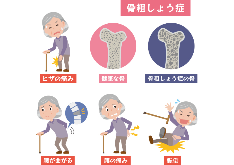 骨粗しょう症